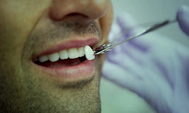 Lentes de contato dental