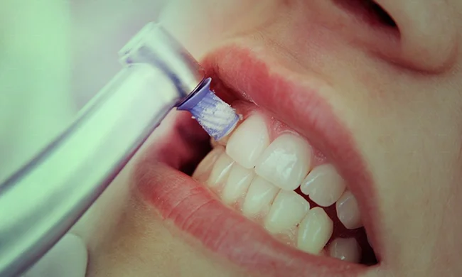 Limpeza dental profissional