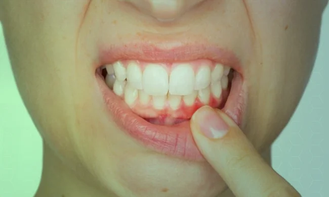 Tratamento periodontal (gengiva)